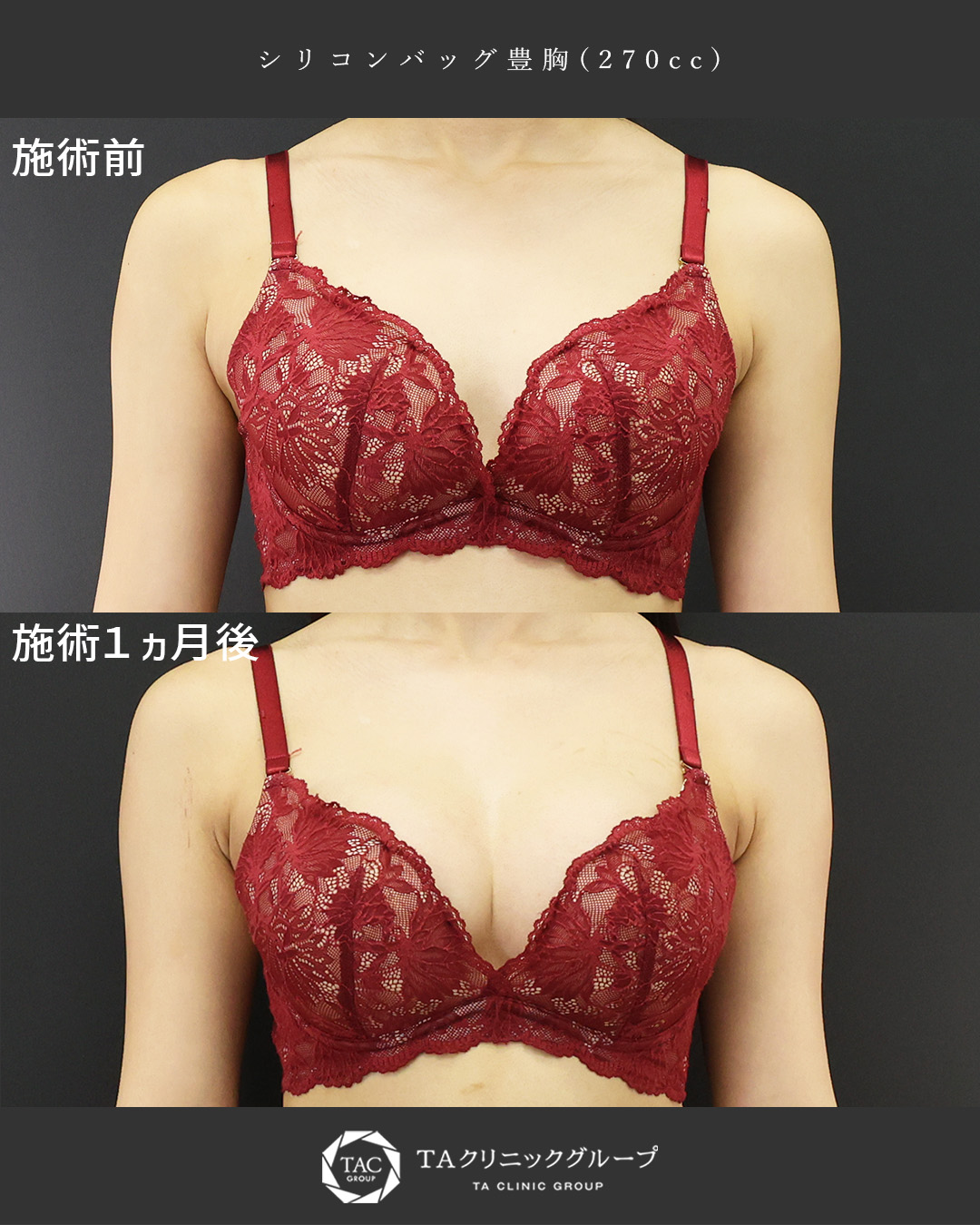 できるだけ自然に大きく豊胸│20代
