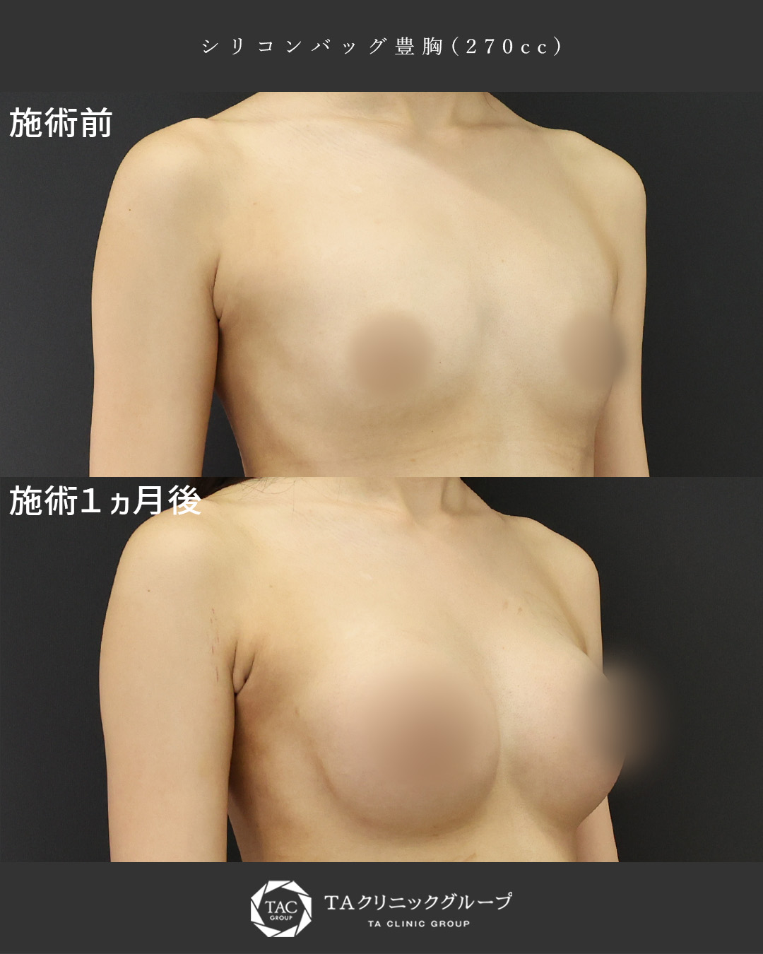 シリコンバッグ豊胸（人工乳腺バッグ）の症例写真 施術前後 
