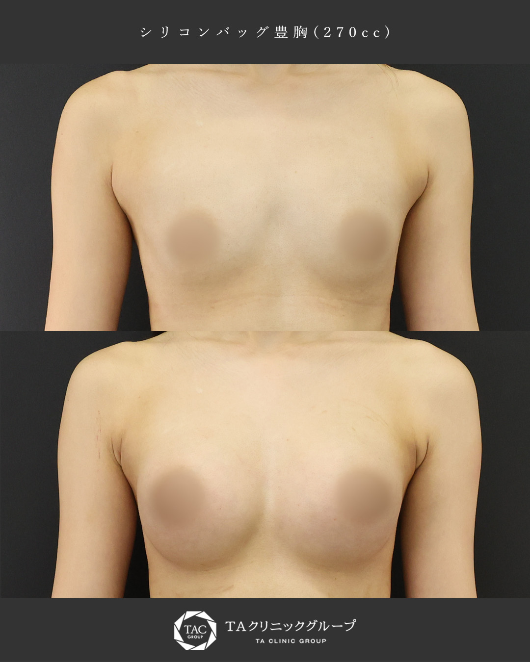 シリコンバッグ豊胸（人工乳腺バッグ）の症例写真 施術前後 