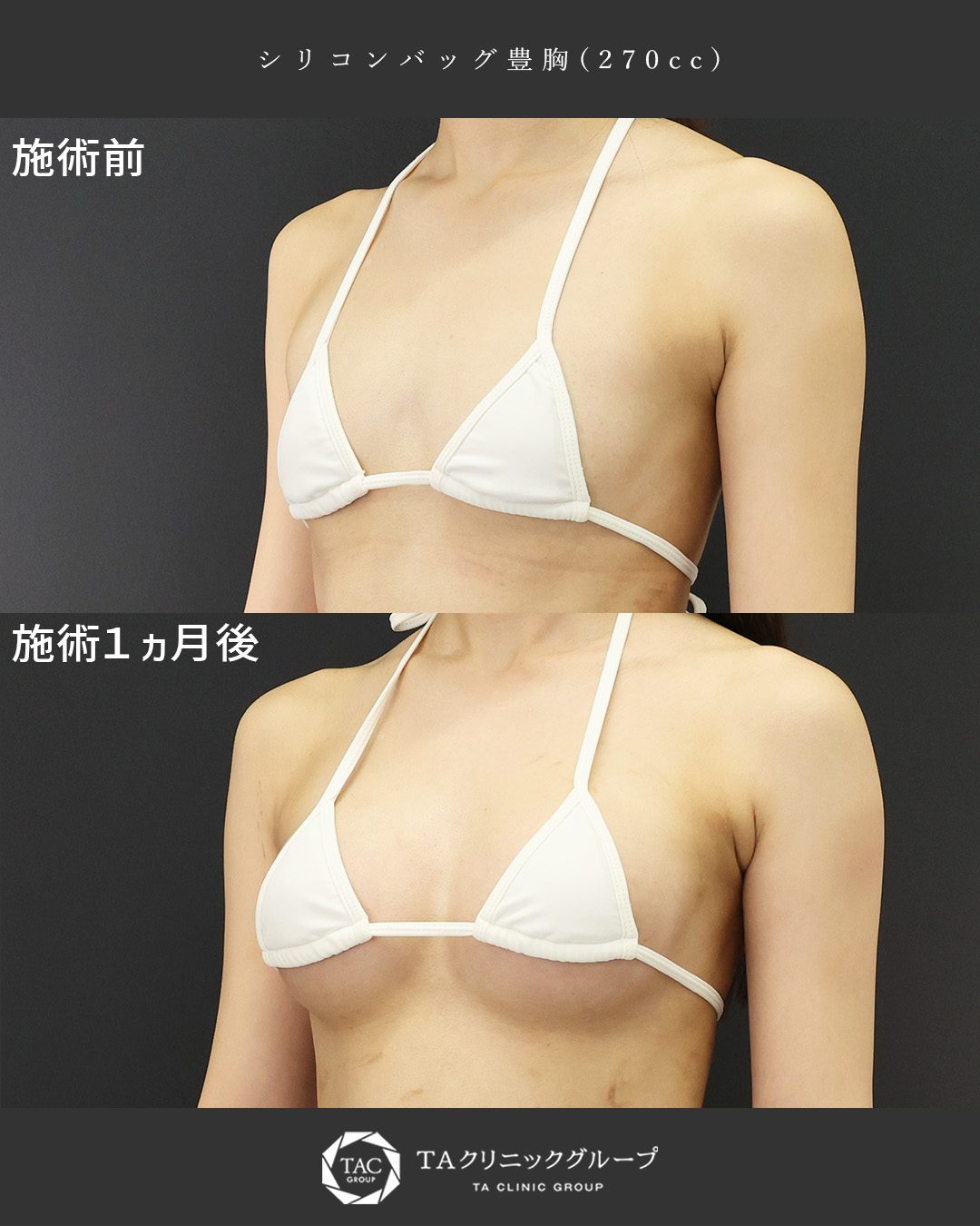 シリコンバッグ豊胸（人工乳腺バッグ）の症例写真 施術前後 