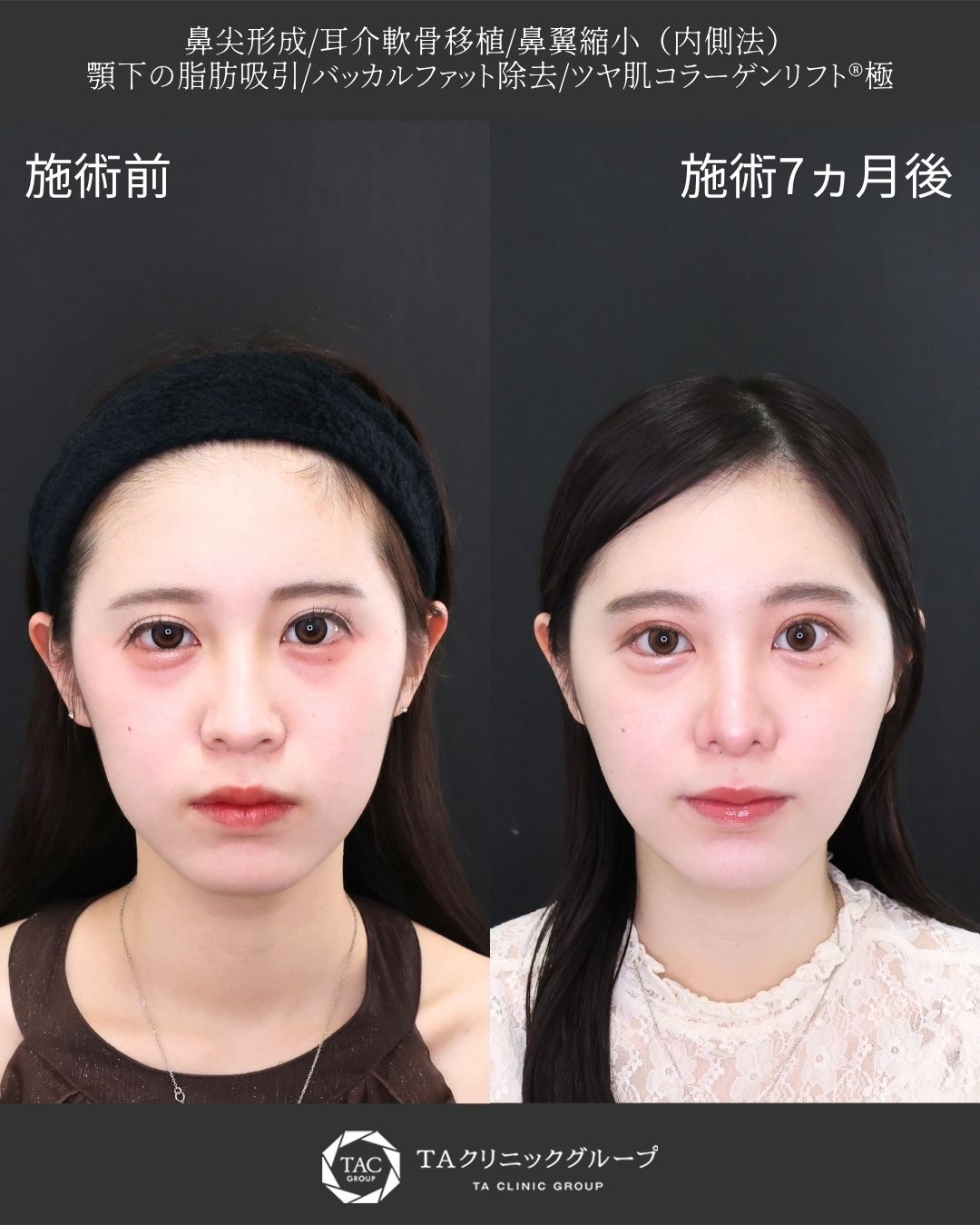 【鼻×小顔整形】｜ナチュラルに顔のバランスを整える