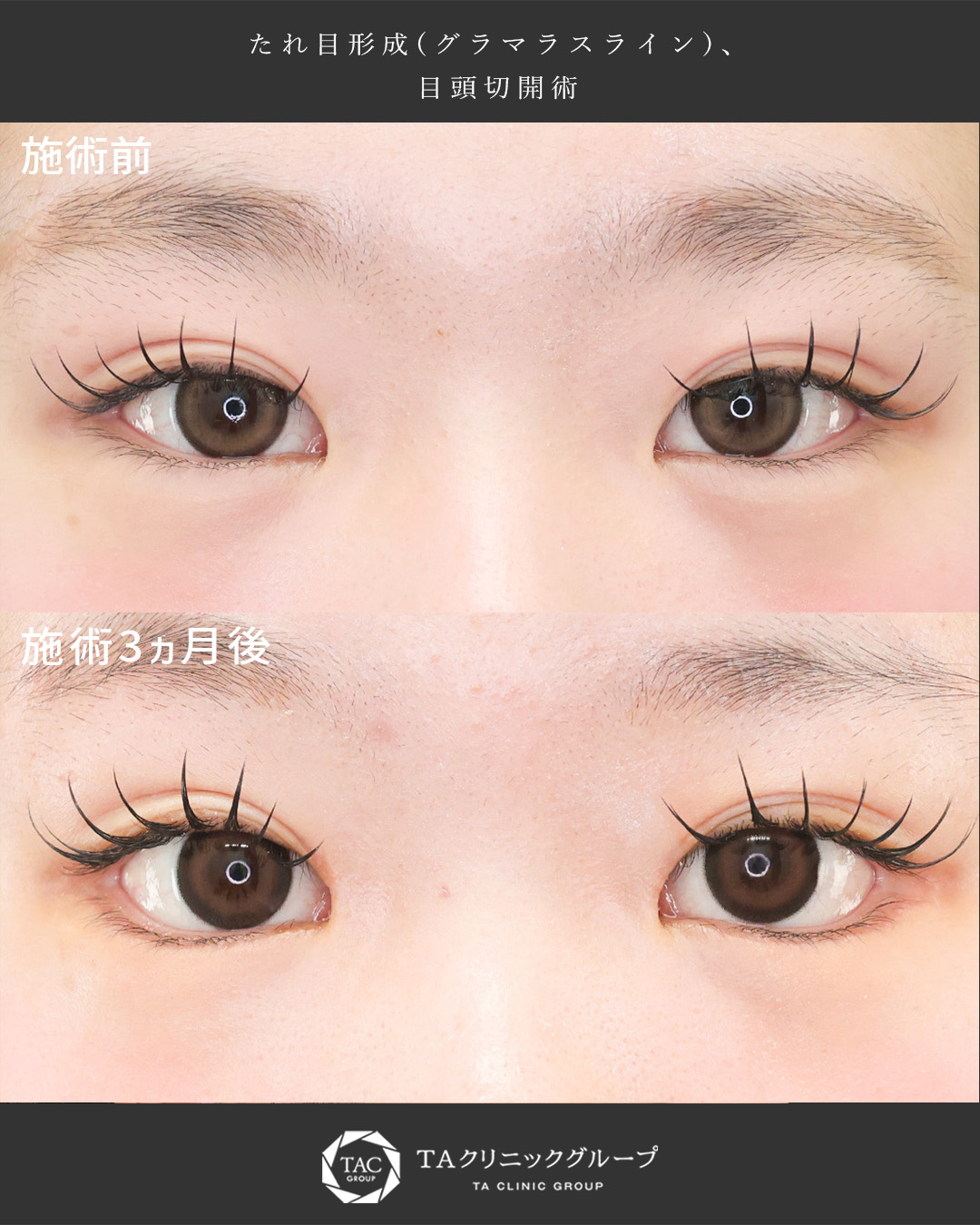 【目頭切開×たれ目形成】つり目のイメージを改善｜形成外科専門医が行う白目拡大術