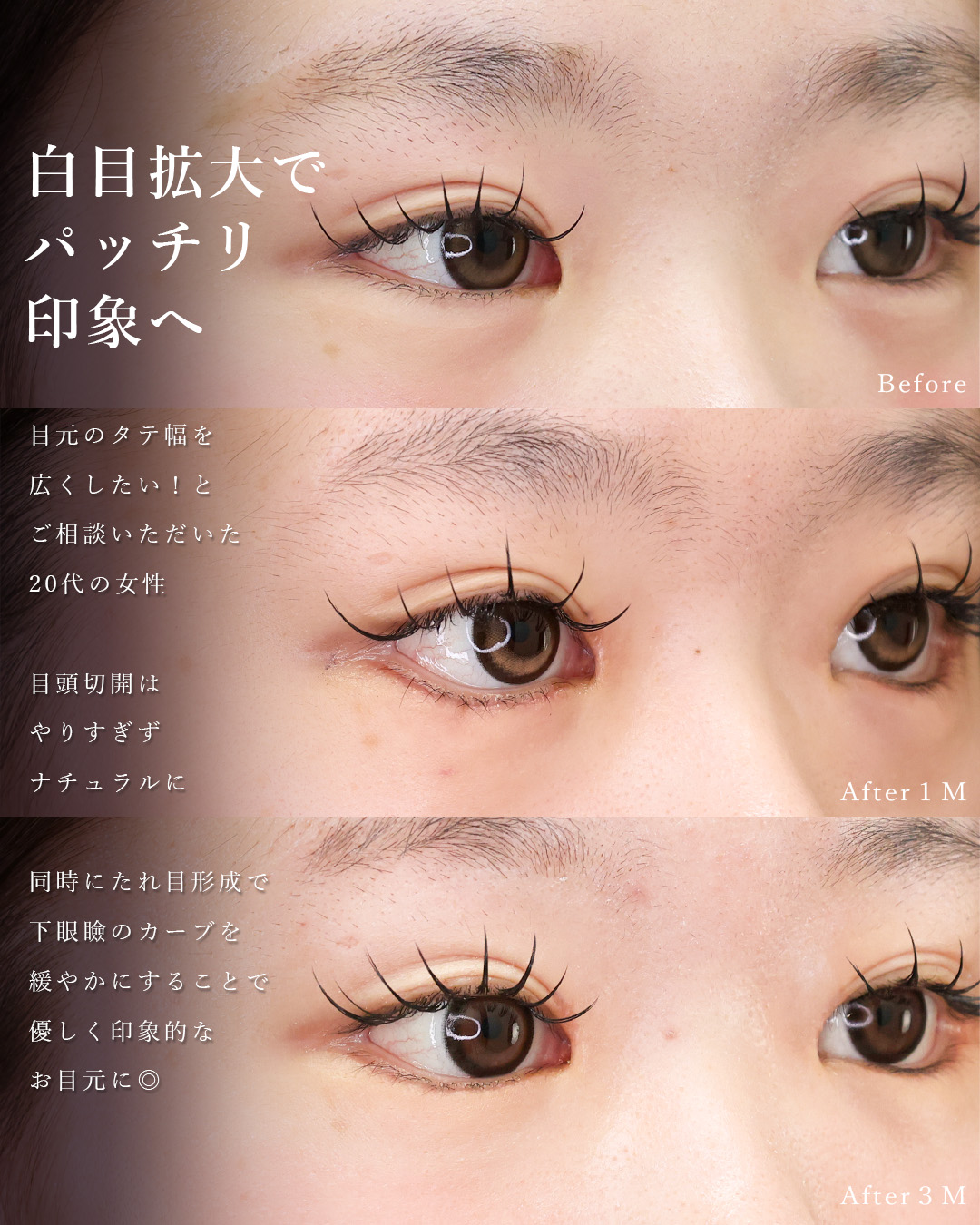 目頭切開術/グラマラスライン（タレ目形成）の症例写真 施術前後 