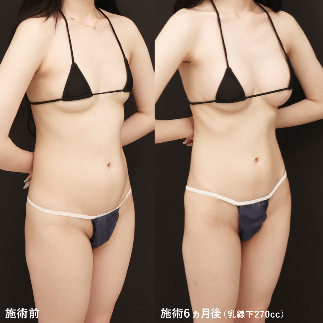 シリコンバッグ豊胸（人工乳腺バッグ）の症例写真 施術前後 