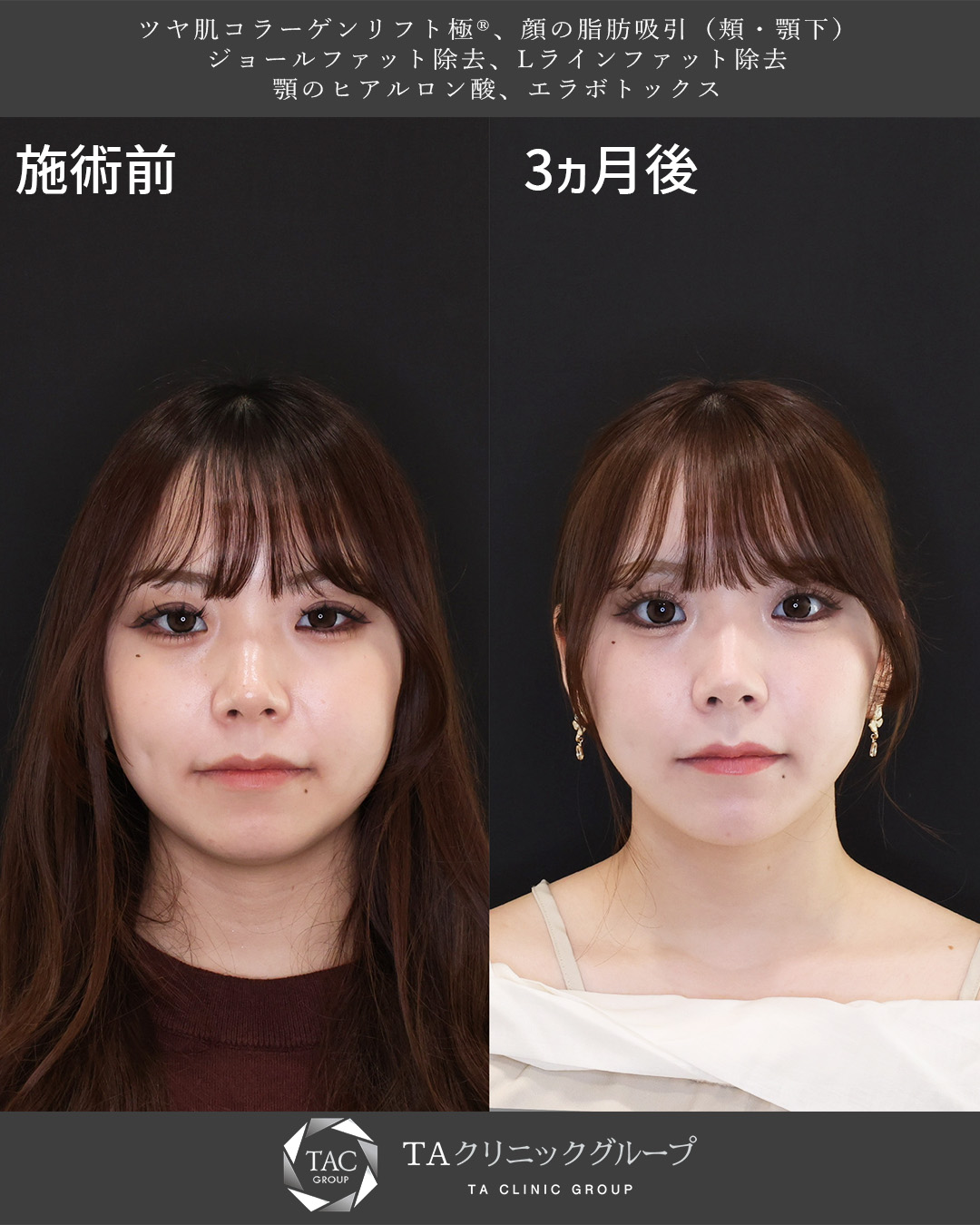 TAC式 ツヤ肌コラーゲンリフト®/Lラインファット除去（エラ下脂肪除去）/ジョールファット除去の症例写真 施術前後 