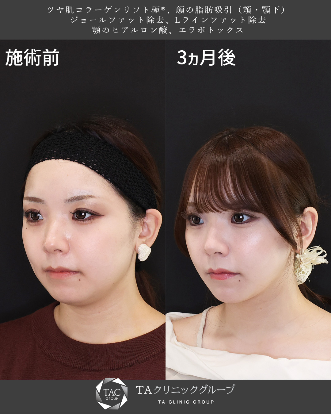 TAC式 ツヤ肌コラーゲンリフト®/Lラインファット除去（エラ下脂肪除去）/ジョールファット除去の症例写真 施術前後 