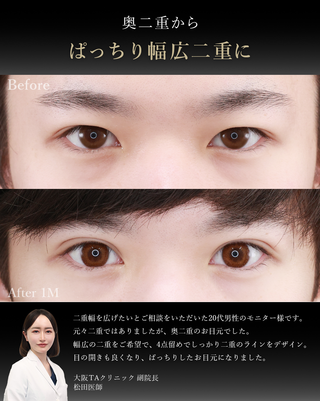 二重埋没法（切らない二重整形）の症例写真 施術前後 