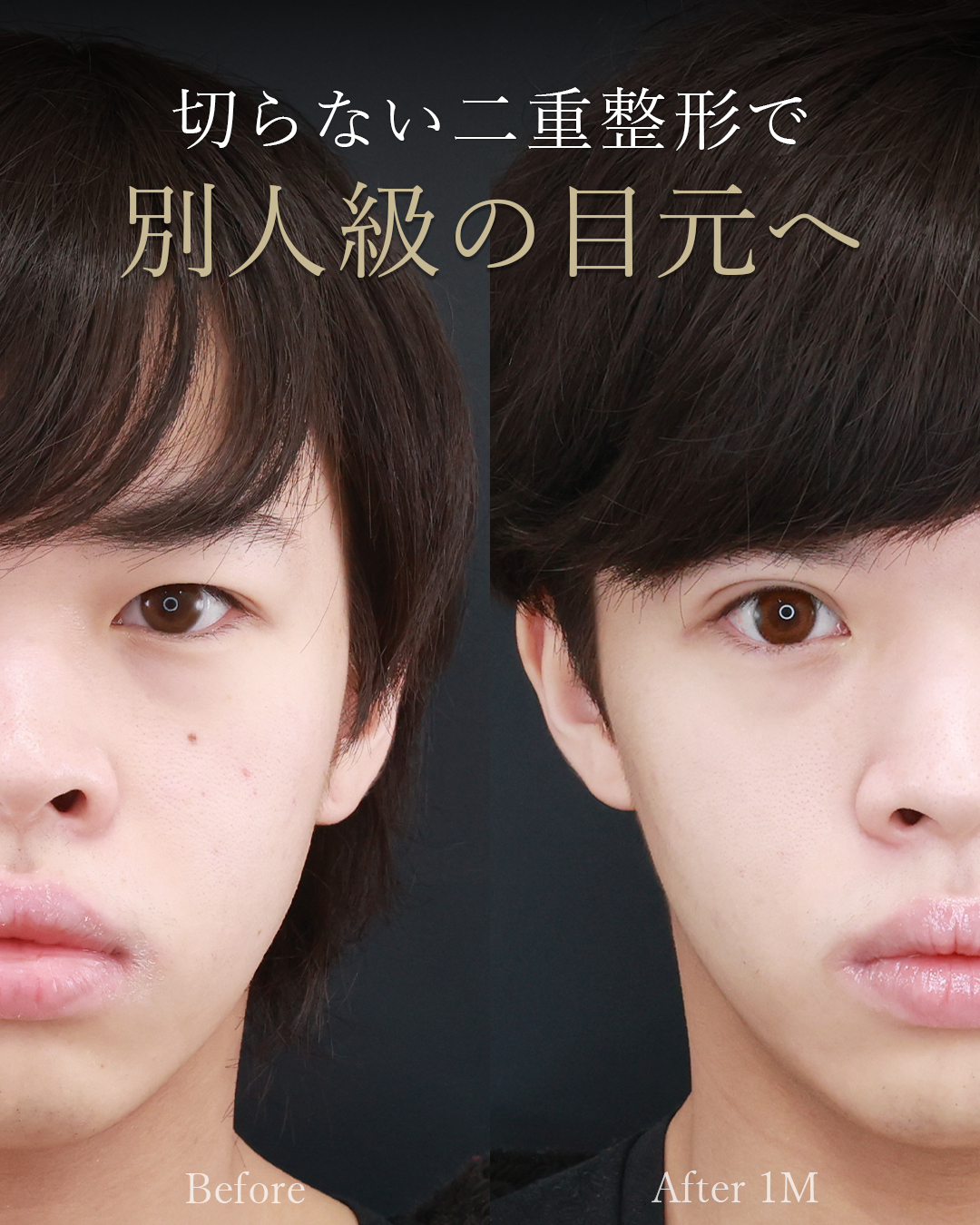 二重埋没法（切らない二重整形）の症例写真 施術前後 