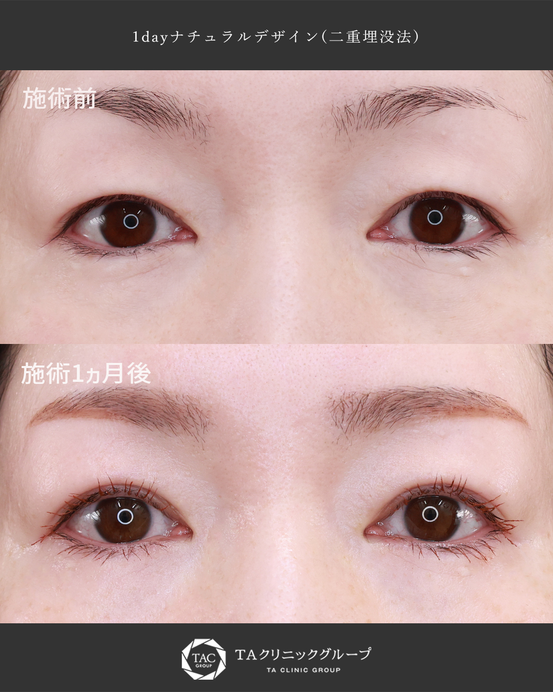 30代女性二重埋没法│二重幅を自然にアップデート