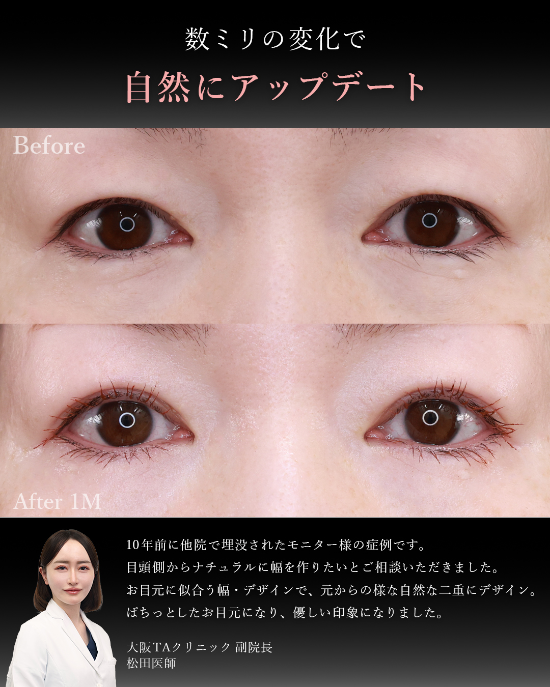 二重埋没法（切らない二重整形）の症例写真 施術前後 