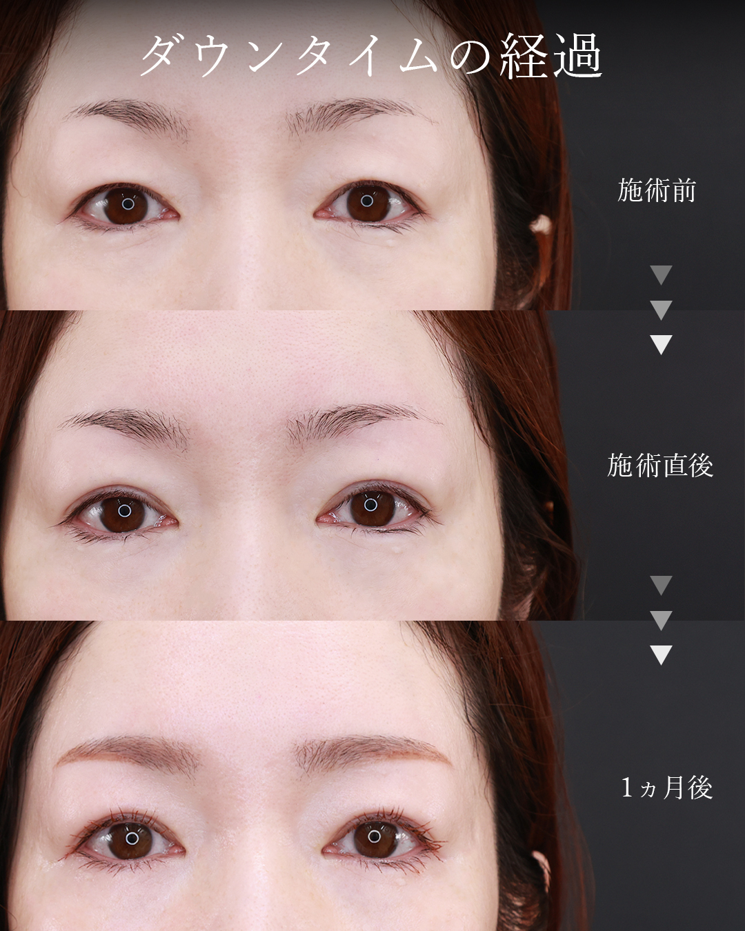 二重埋没法（切らない二重整形）の症例写真 施術前後 