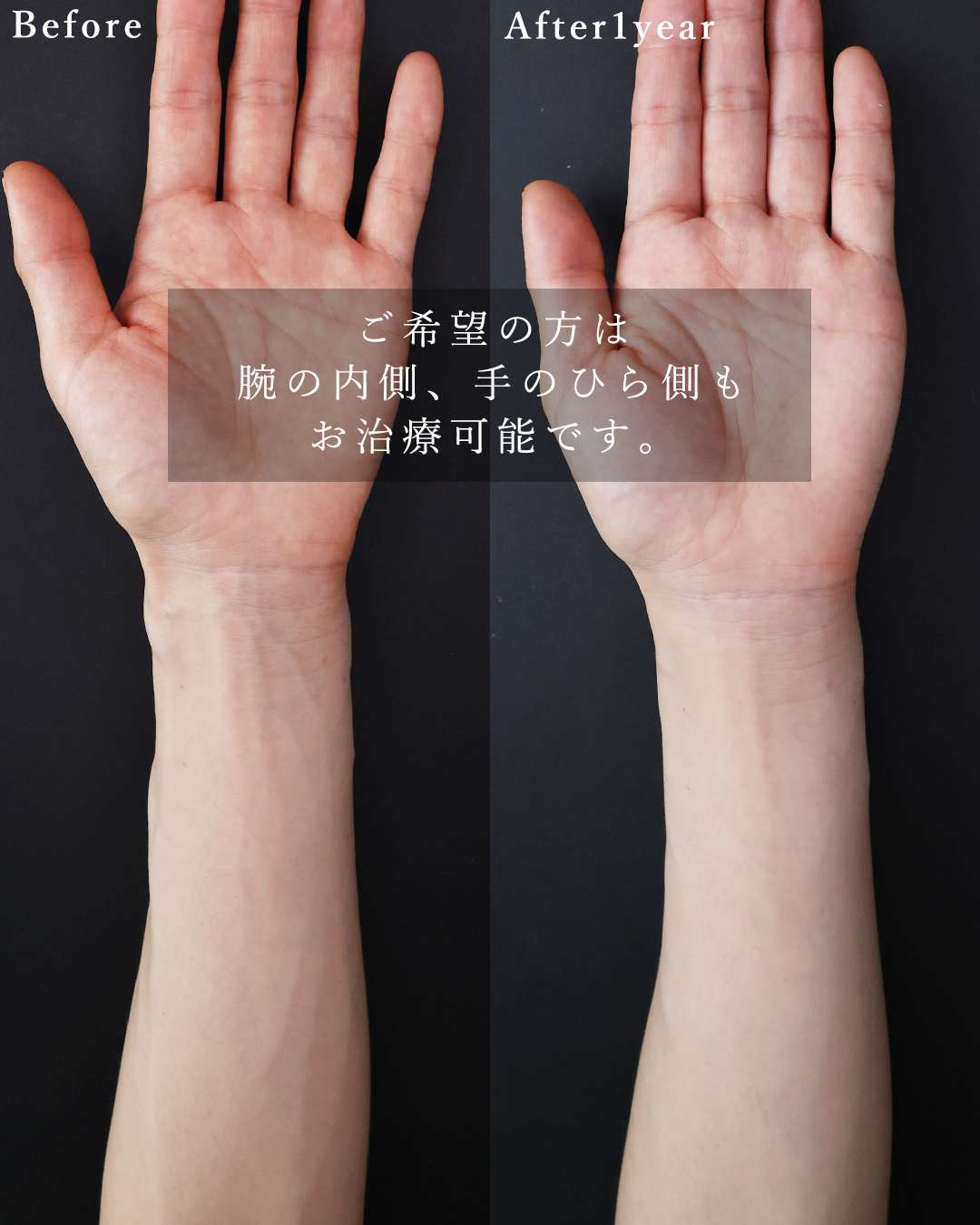 ハンドベイン（手のアンチエイジング・血管治療）の症例写真 施術前後 