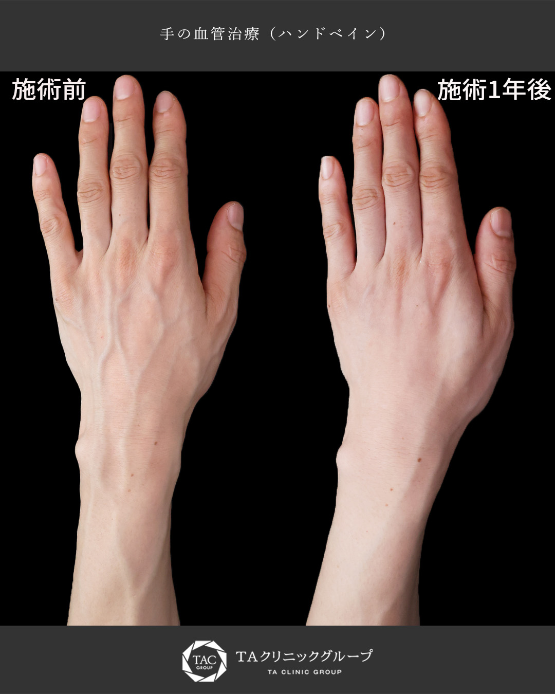 手の血管治療から1年後。1度の治療でここまで綺麗に。
