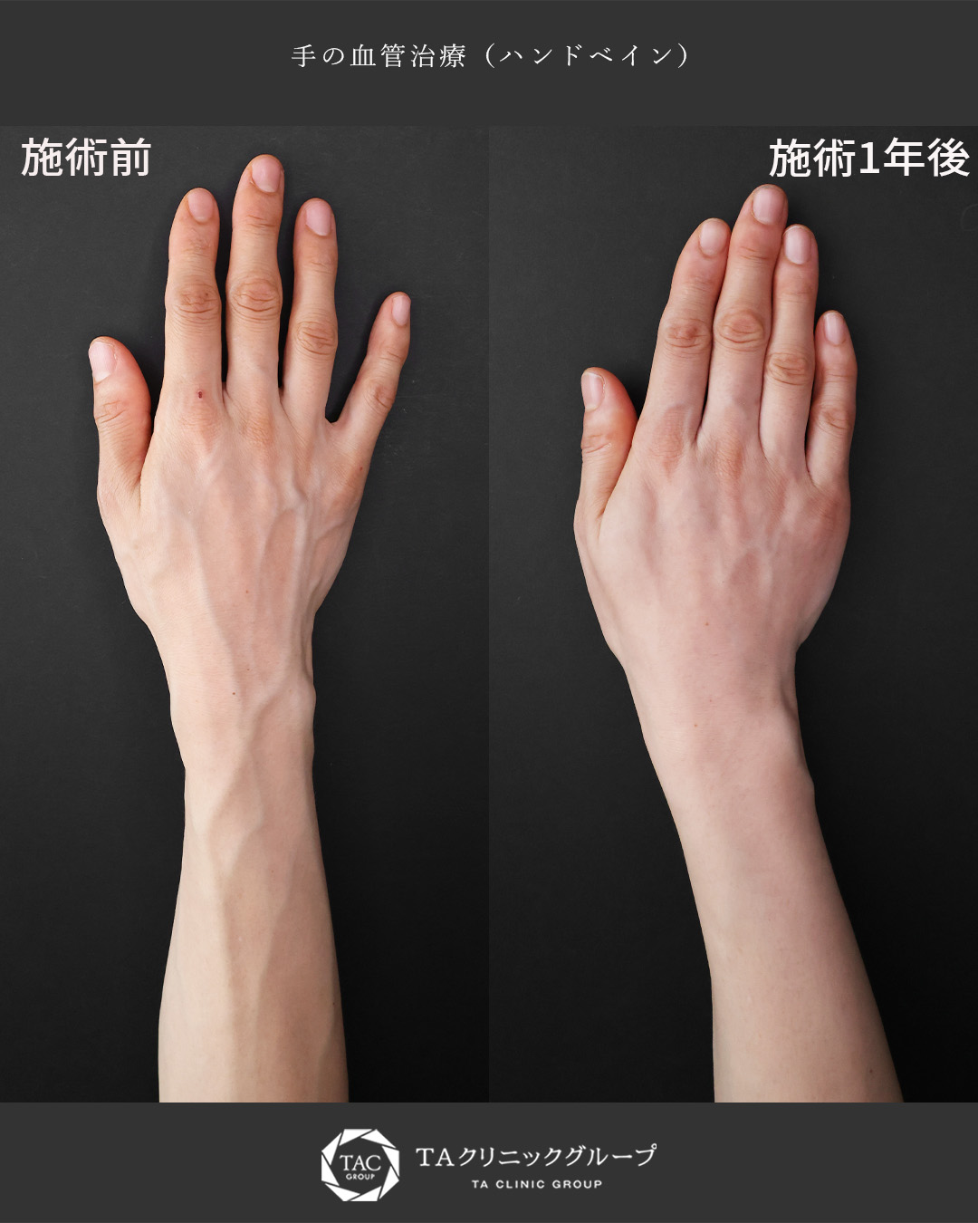 【手の血管治療】１度の治療で裏も表も綺麗な手に