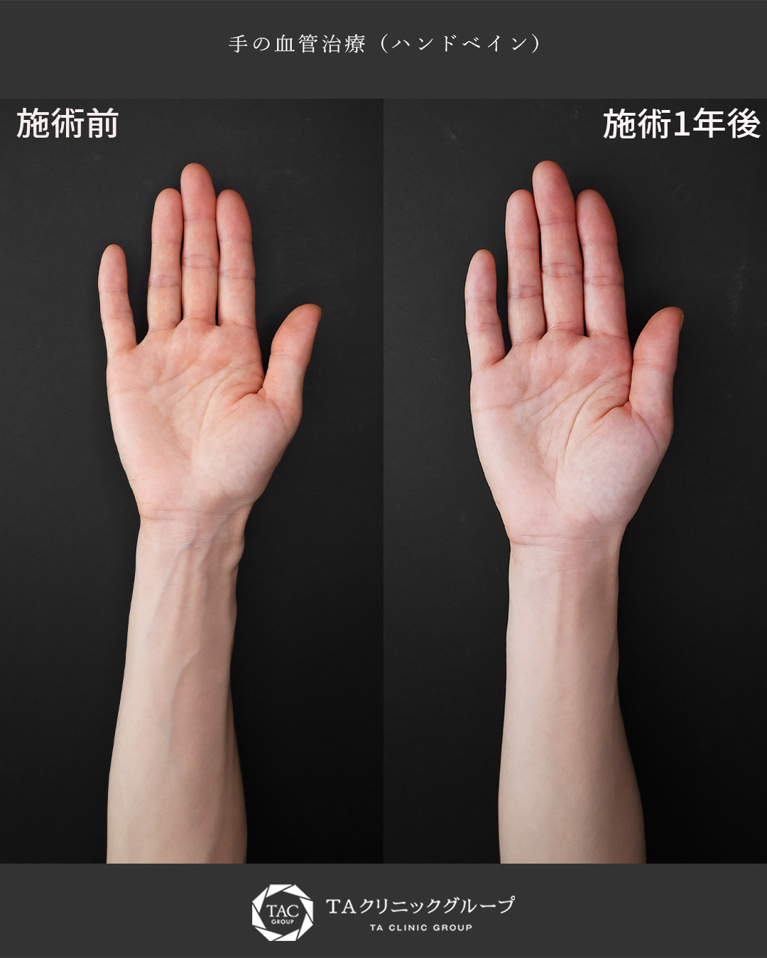 ハンドベイン（手のアンチエイジング・血管治療）の症例写真 施術前後 