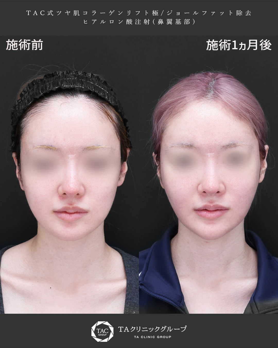 美しさに、もうひと磨き。糸リフトでよりシャープなフェイスラインに