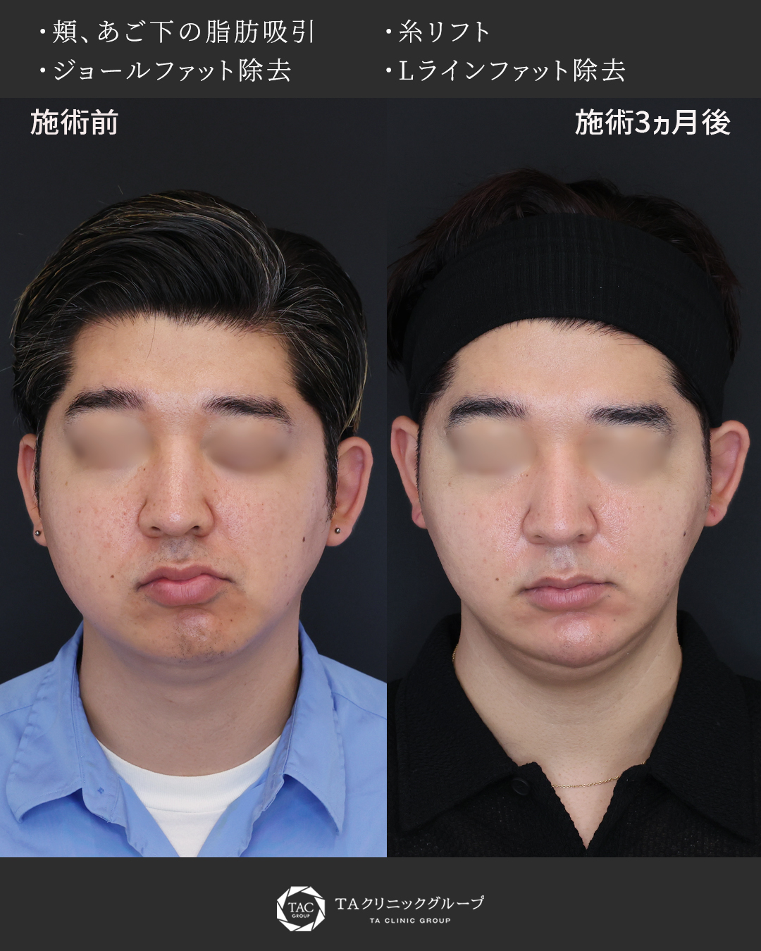 30代、男性の小顔治療　余分な脂肪を取り除いて顔のボリュームダウン