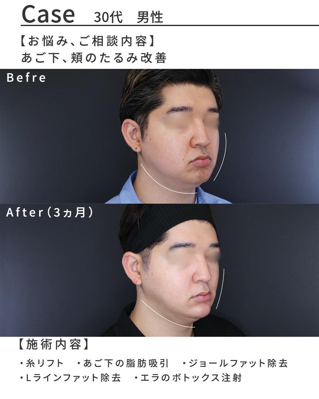 TAC式 ツヤ肌コラーゲンリフト®/ジョールファット除去/Lラインファット除去（エラ下脂肪除去）の症例写真 施術前後 