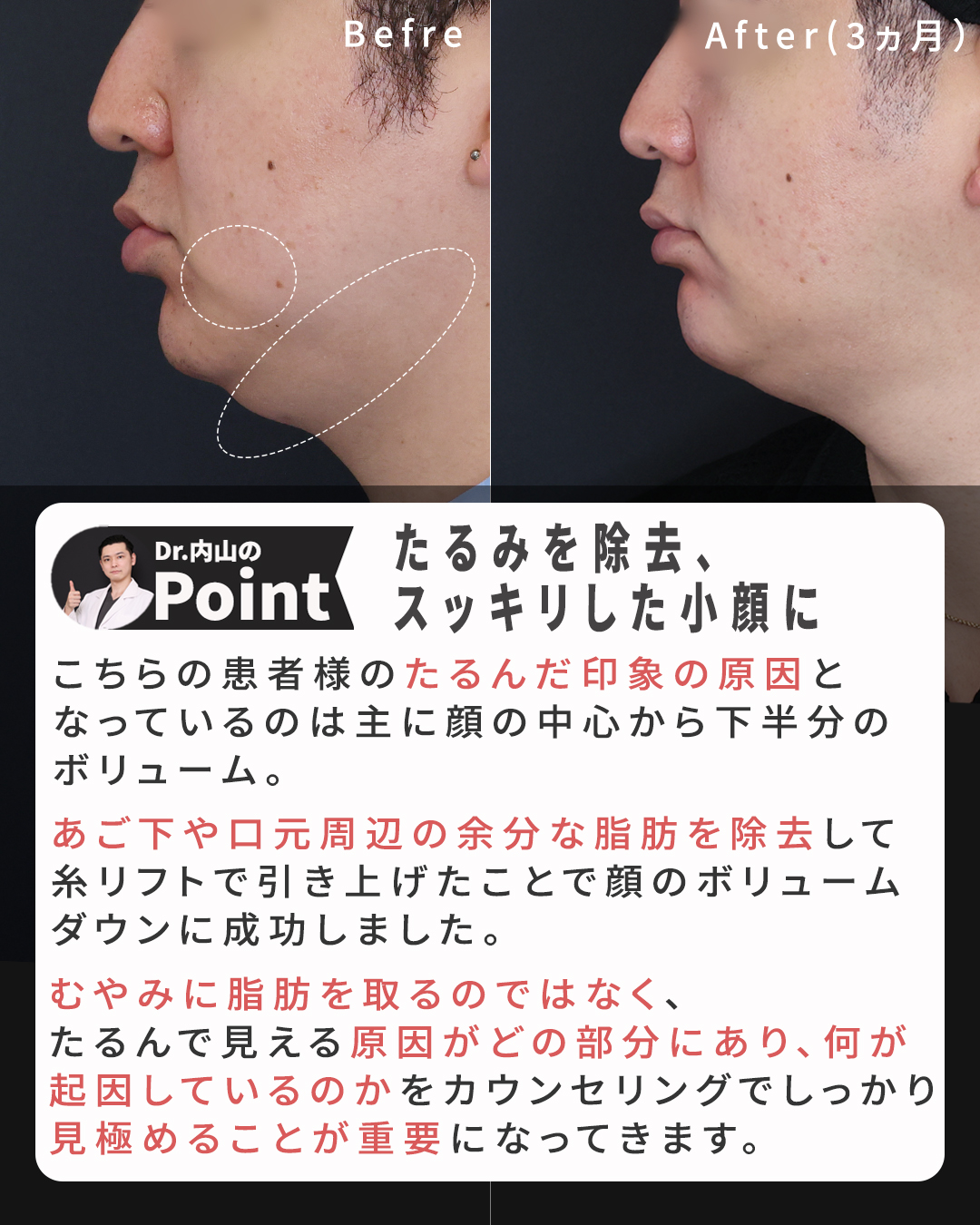 TAC式 ツヤ肌コラーゲンリフト®/ジョールファット除去/Lラインファット除去（エラ下脂肪除去）の症例写真 施術前後 