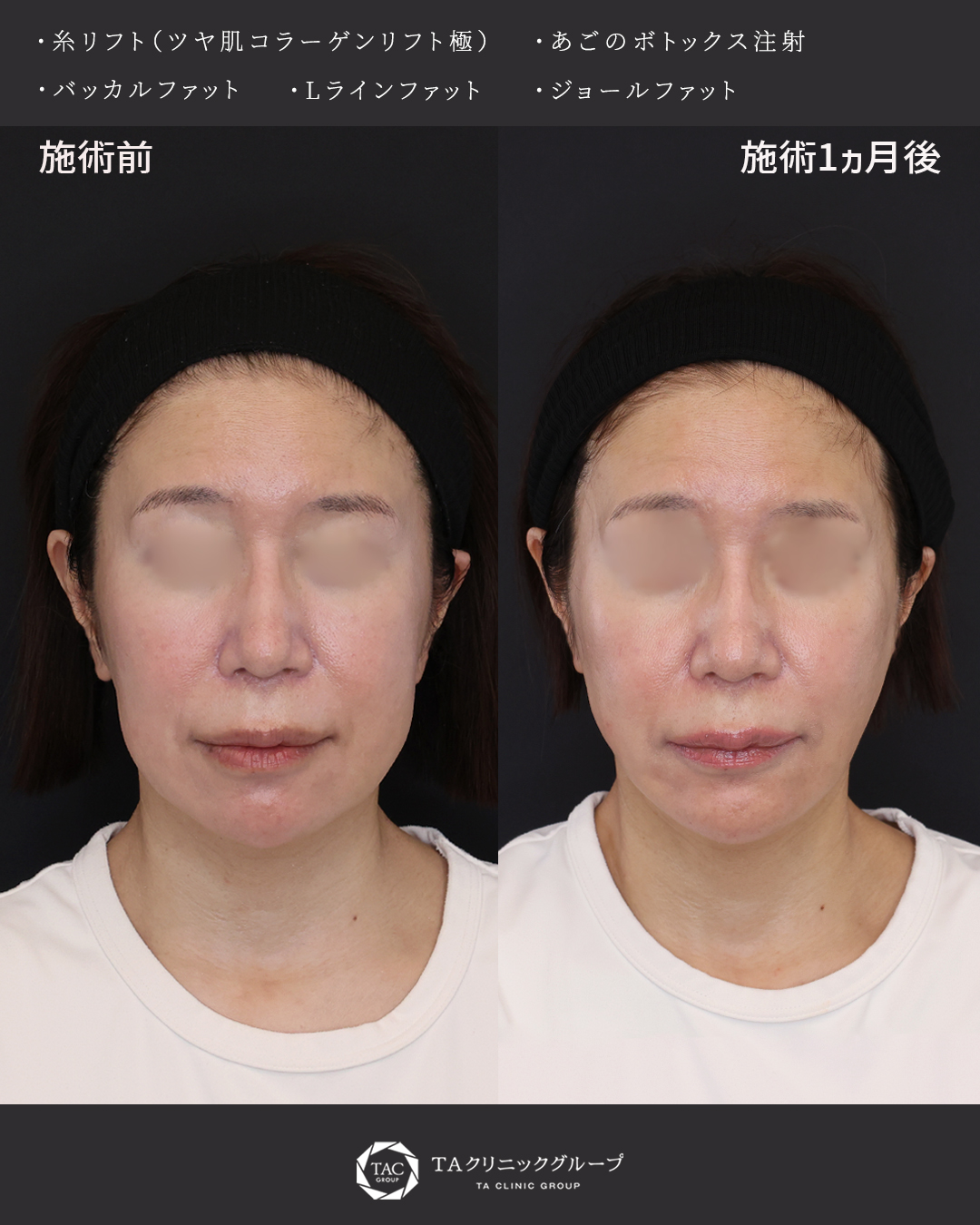 加齢によるたるみに脂肪除去×糸リフト