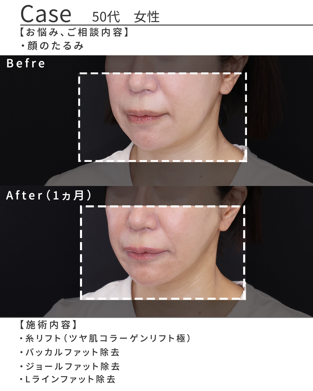 TAC式 ツヤ肌コラーゲンリフト®/ジョールファット除去/バッカルファット除去の症例写真 施術前後 