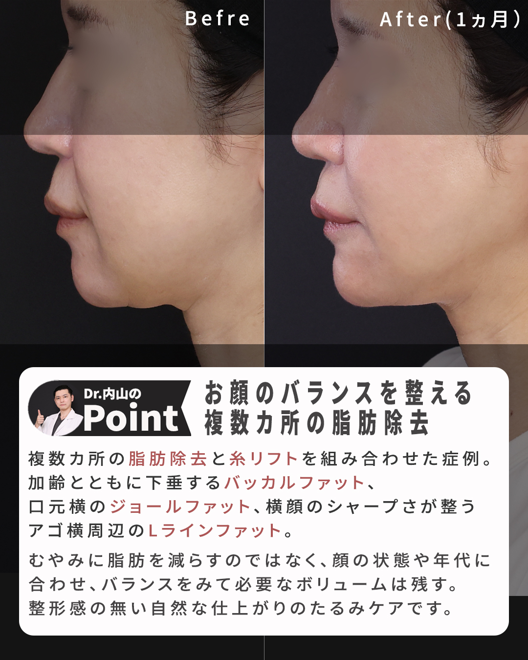 TAC式 ツヤ肌コラーゲンリフト®/ジョールファット除去/バッカルファット除去の症例写真 施術前後 