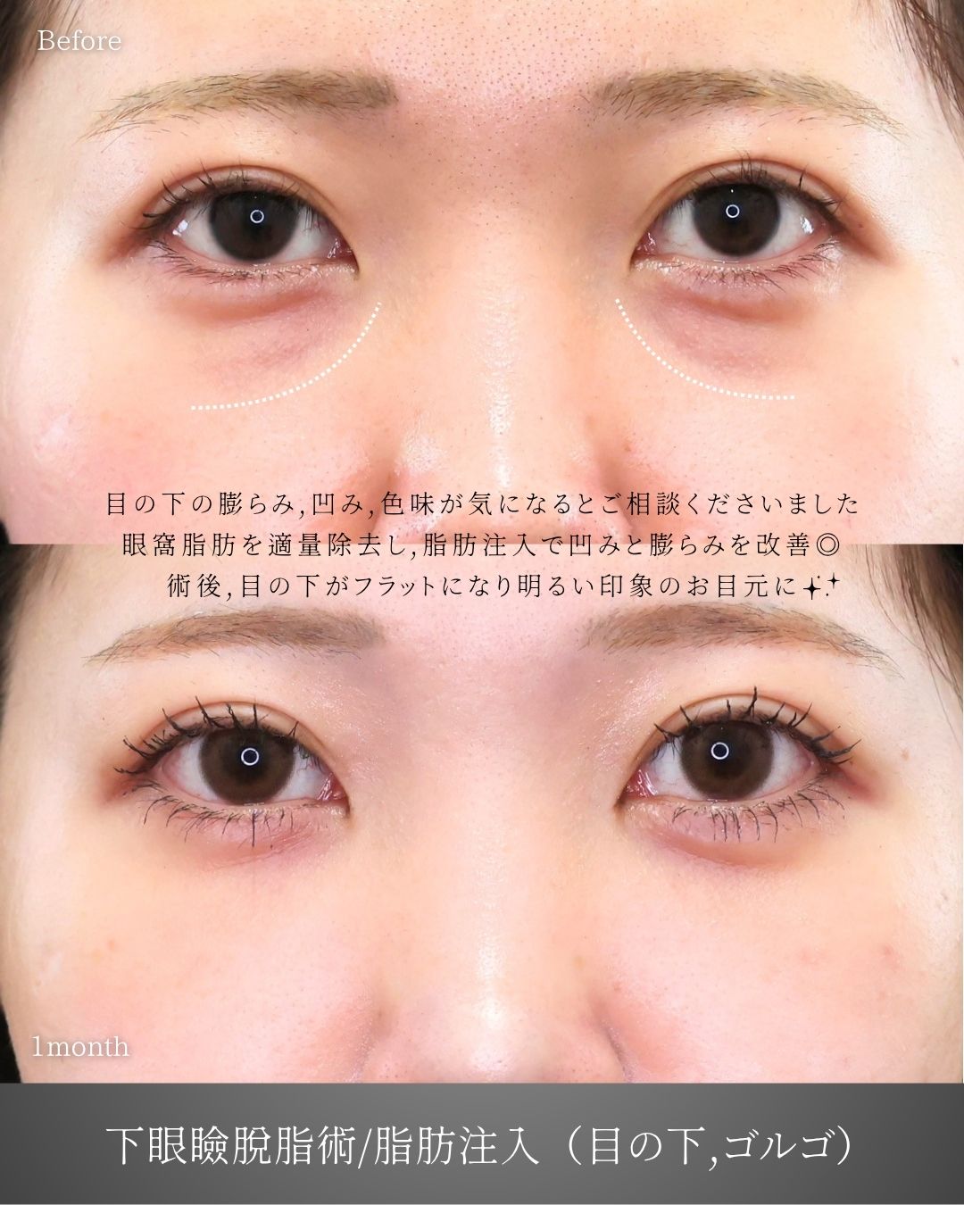 下眼瞼脱脂術（目の下のたるみ取り・目の下の脂肪ふくらみ取り）/顔の脂肪注入(コンデンスリッチフェイス)の症例写真 施術前後 
