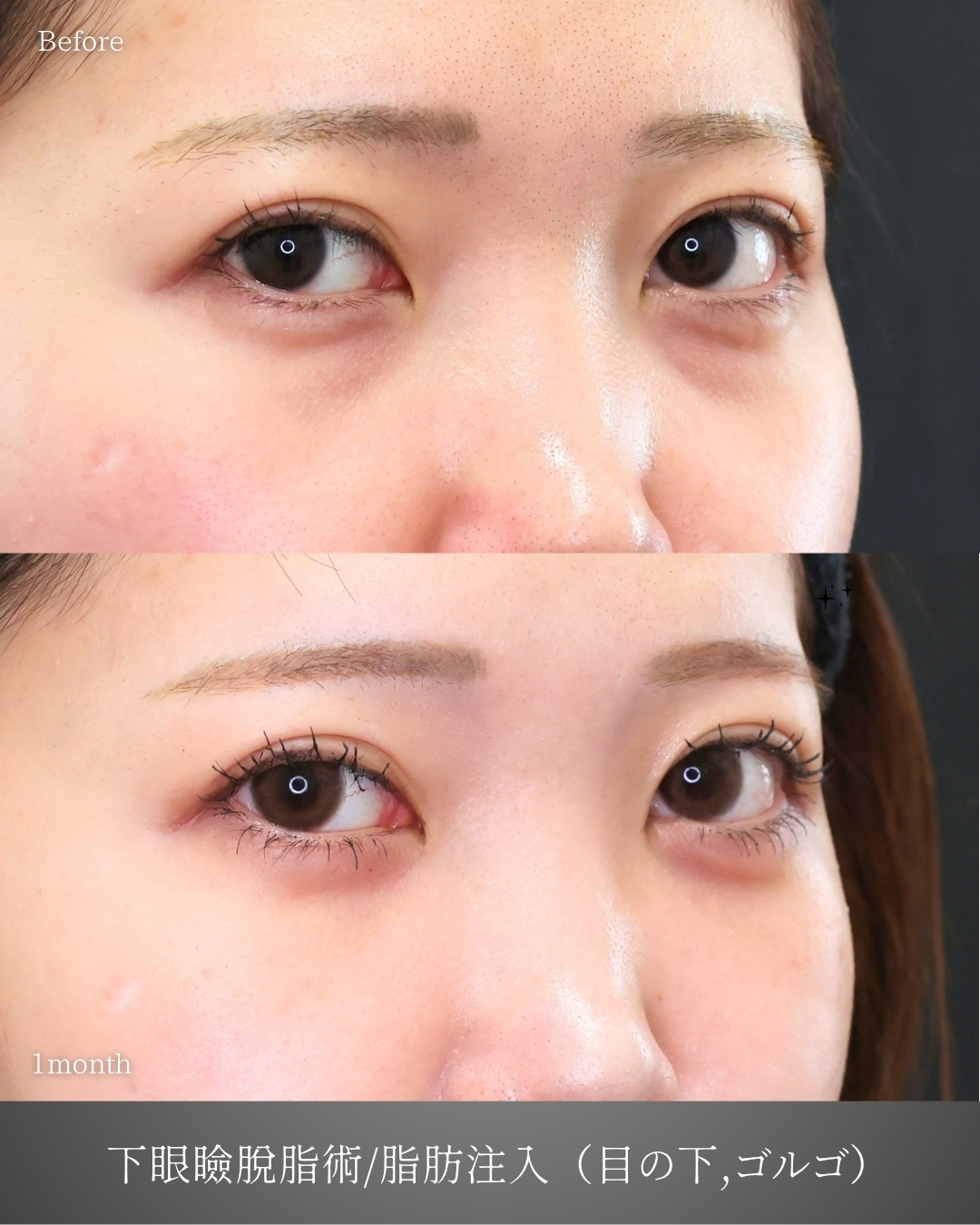 下眼瞼脱脂術（目の下のたるみ取り・目の下の脂肪ふくらみ取り）/顔の脂肪注入(コンデンスリッチフェイス)の症例写真 施術前後 