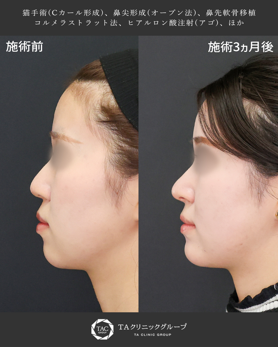 【猫手術】元の状態を生かした鼻整形｜形成外科専門医執刀