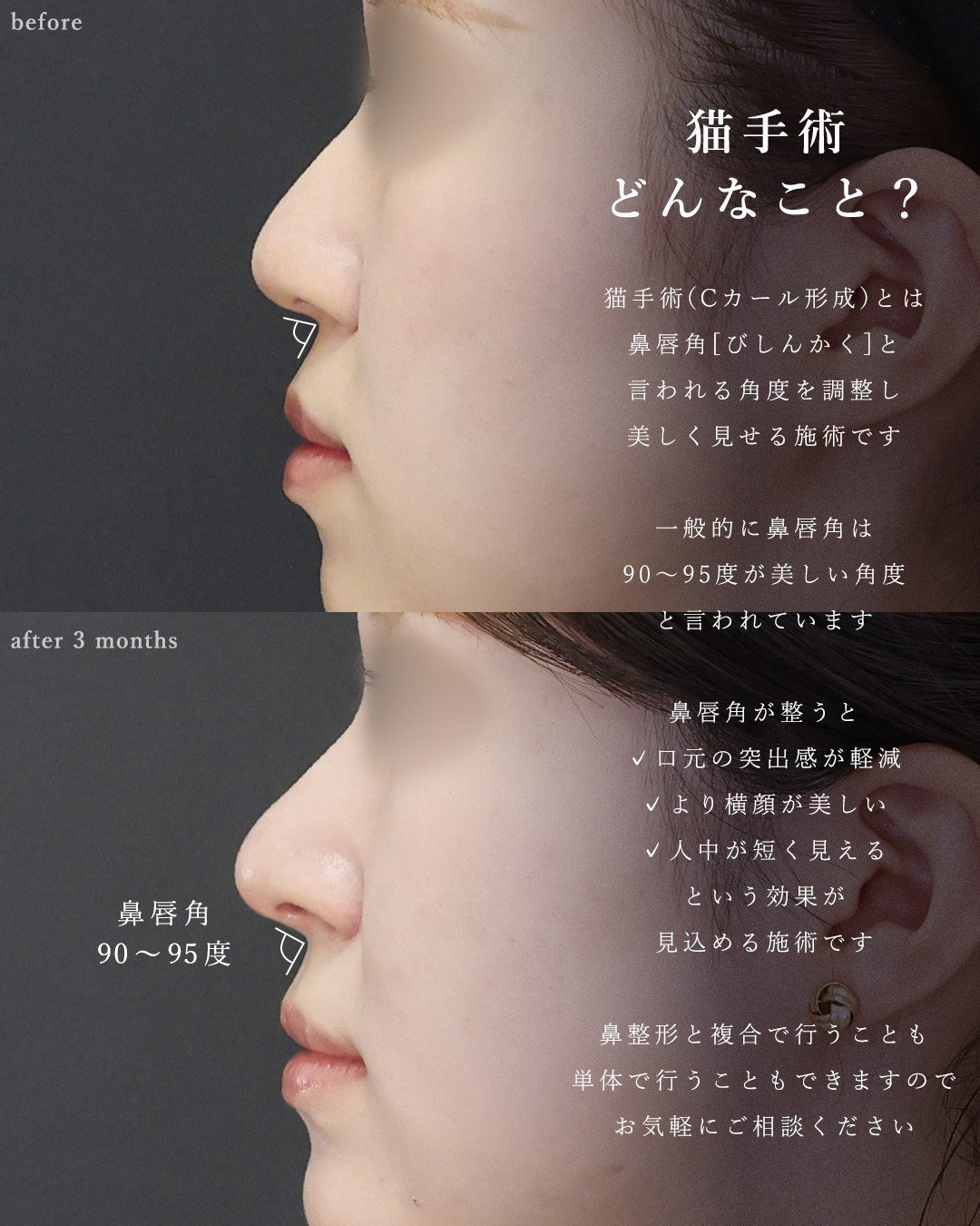 鼻唇角形成術・猫手術/鼻尖形成・鼻尖縮小/鼻先軟骨移植の症例写真 施術前後 