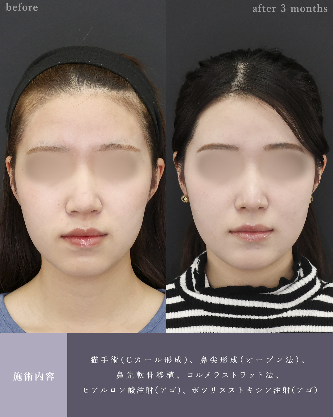 鼻唇角形成術・猫手術/鼻尖形成・鼻尖縮小/鼻先軟骨移植の症例写真 施術前後 