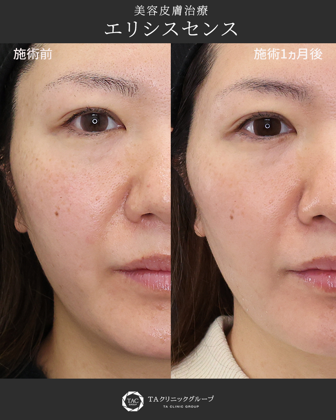 悩める30代の【毛穴】解決方法