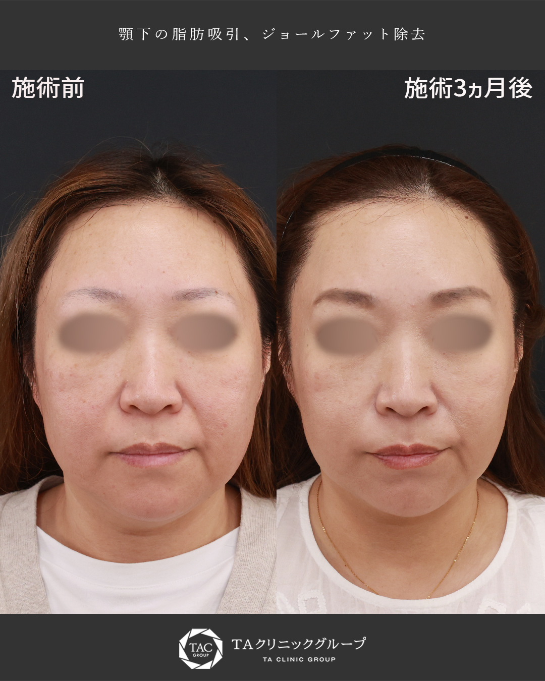 自然に顔痩せしたように│形成外科専門医が執刀するお顔の脂肪吸引
