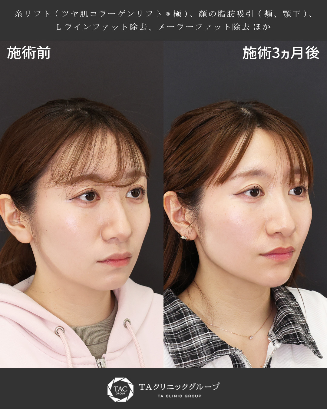 より美しさを磨く│20代小顔整形