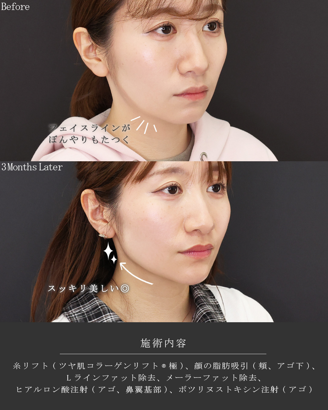 TAC式 ツヤ肌コラーゲンリフト®/顎下の脂肪吸引・顔の脂肪吸引/Lラインファット除去（エラ下脂肪除去）の症例写真 施術前後 