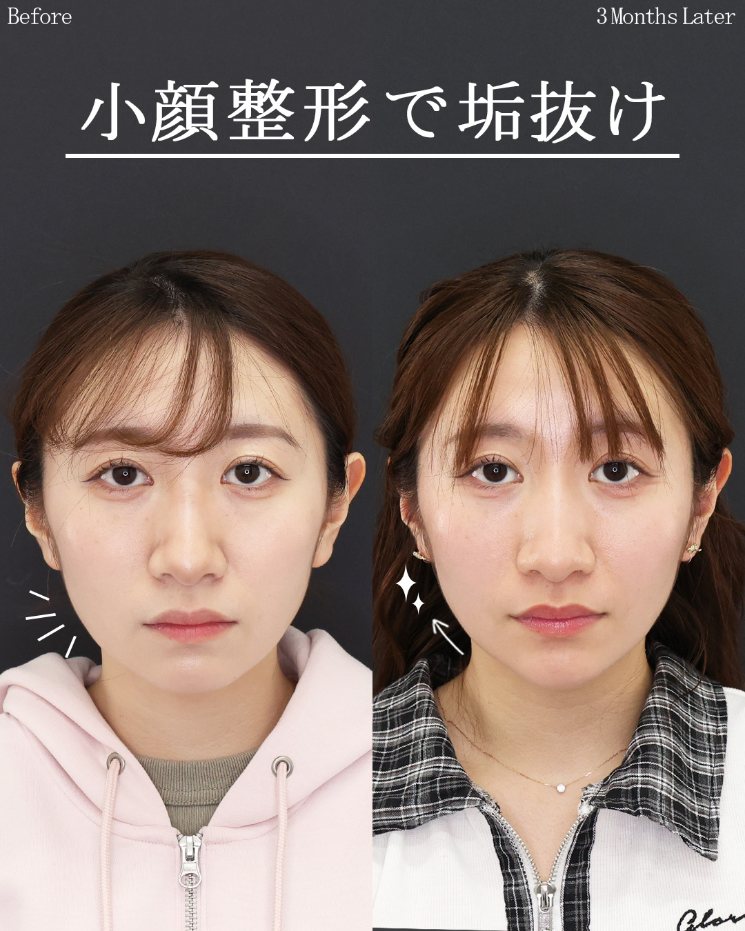 TAC式 ツヤ肌コラーゲンリフト®/顎下の脂肪吸引・顔の脂肪吸引/Lラインファット除去（エラ下脂肪除去）の症例写真 施術前後 