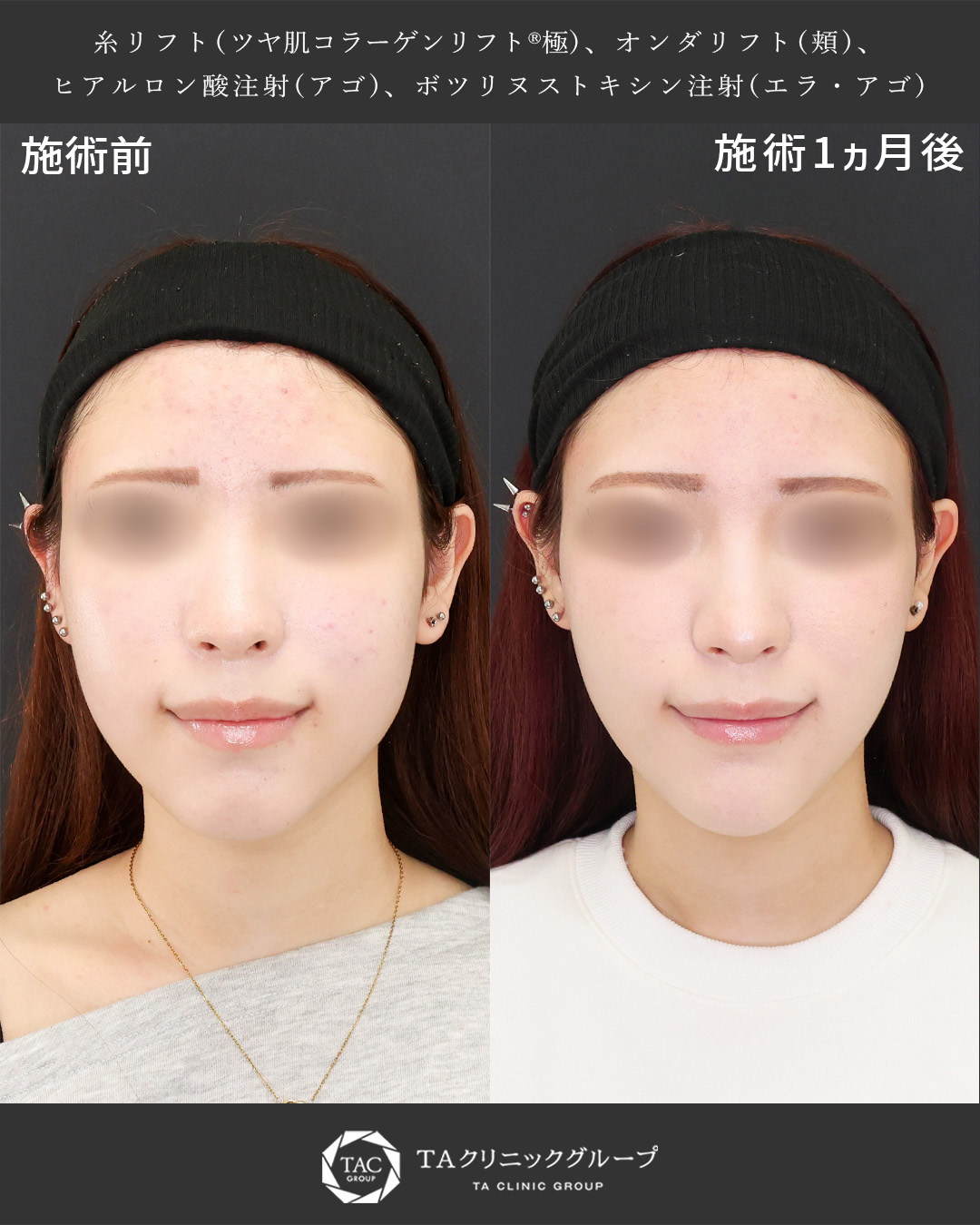 オンダリフト×糸リフトで最短で小顔に