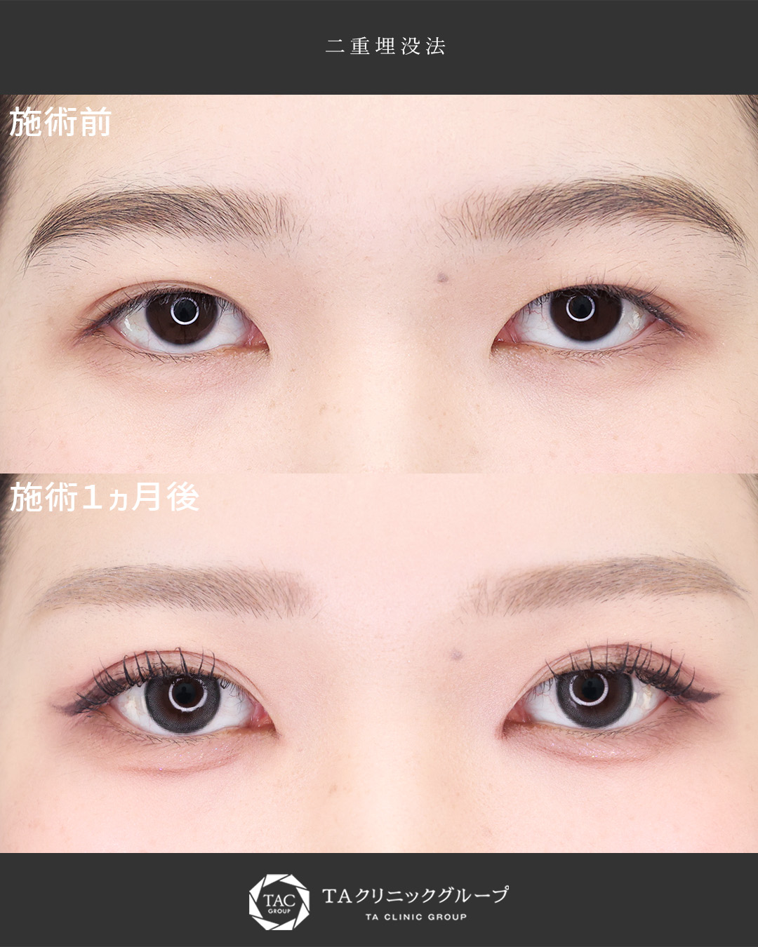 念願のアイプチ卒業│ぱっちり可愛い目元に◎