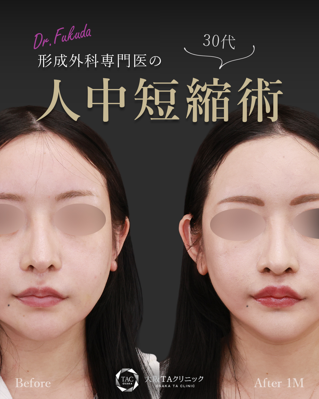 人中短縮術(リップリフト)・外側人中短縮術/ボトックス注射：その他/TAC式 鼻翼縮小術（小鼻縮小）の症例写真 施術前後 