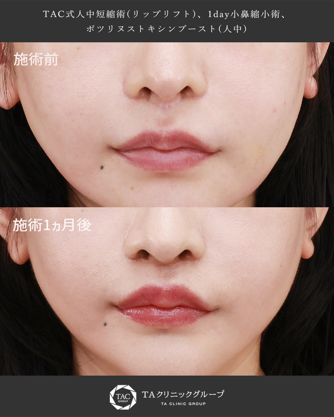２回目でも綺麗な仕上がりに│形成外科専門医の人中短縮術