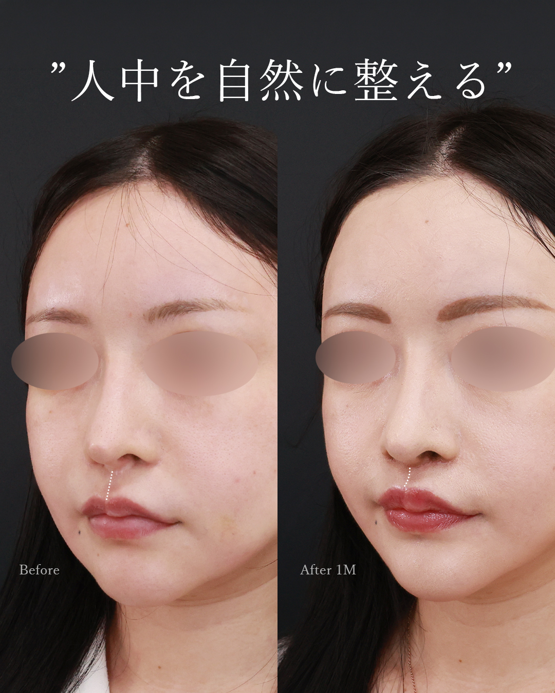 人中短縮術(リップリフト)・外側人中短縮術/ボトックス注射：その他/TAC式 鼻翼縮小術（小鼻縮小）の症例写真 施術前後 