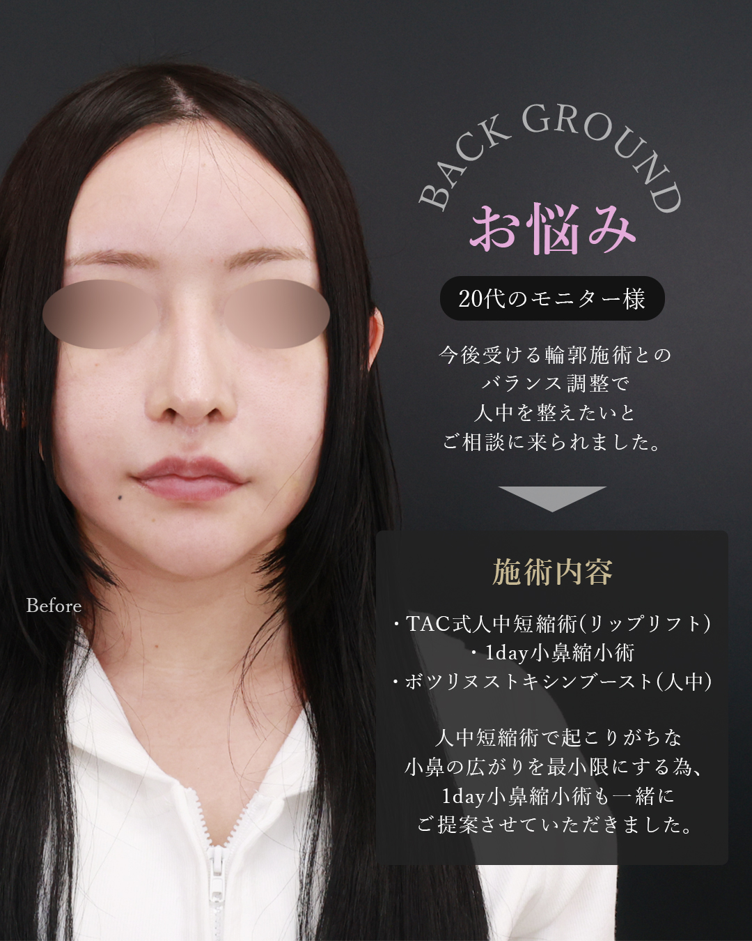 人中短縮術(リップリフト)・外側人中短縮術/ボトックス注射：その他/TAC式 鼻翼縮小術（小鼻縮小）の症例写真 施術前後 