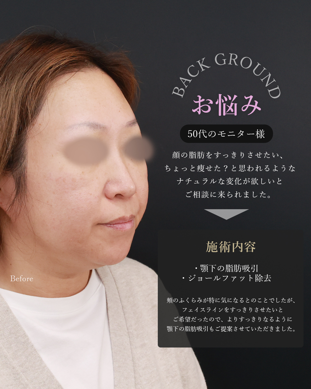 顎下の脂肪吸引・顔の脂肪吸引/ジョールファット除去の症例写真 施術前後 