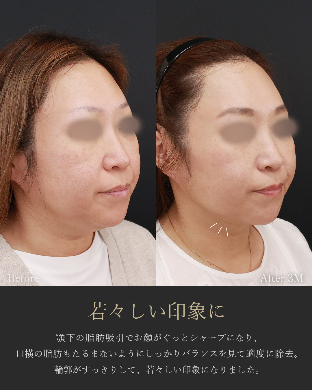 顎下の脂肪吸引・顔の脂肪吸引/ジョールファット除去の症例写真 施術前後 
