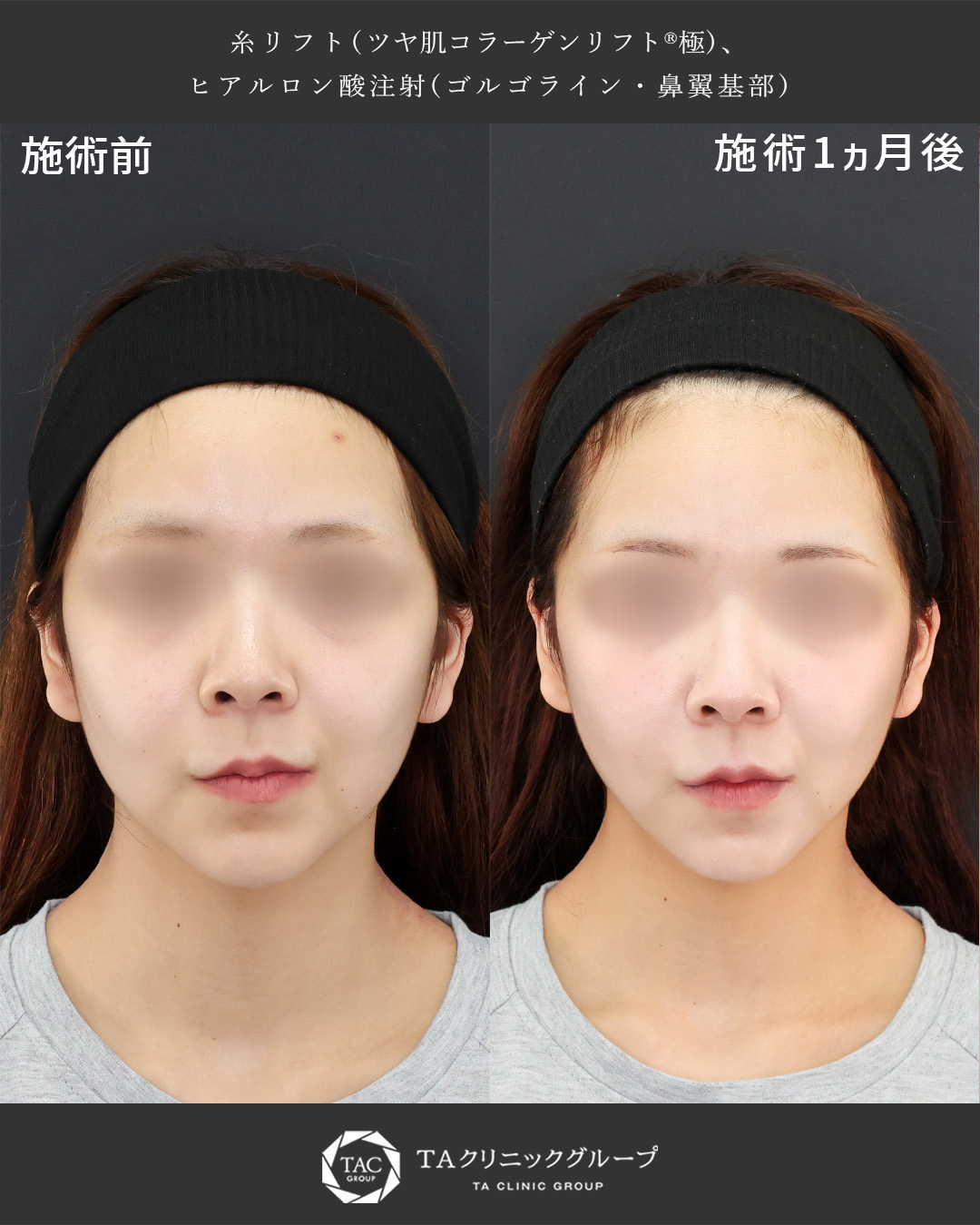 バランスを整え小顔にするTAC糸リフト