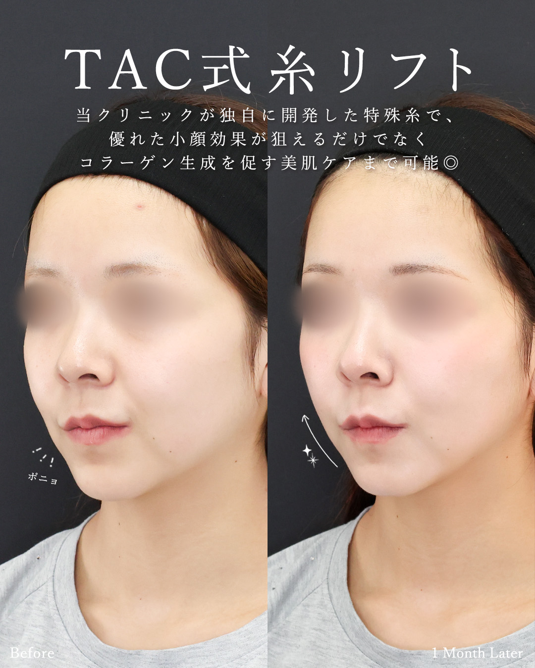 TAC式 ツヤ肌コラーゲンリフト®/ゴルゴ線のヒアルロン酸注射/ヒアルロン酸注射：その他の症例写真 施術前後 