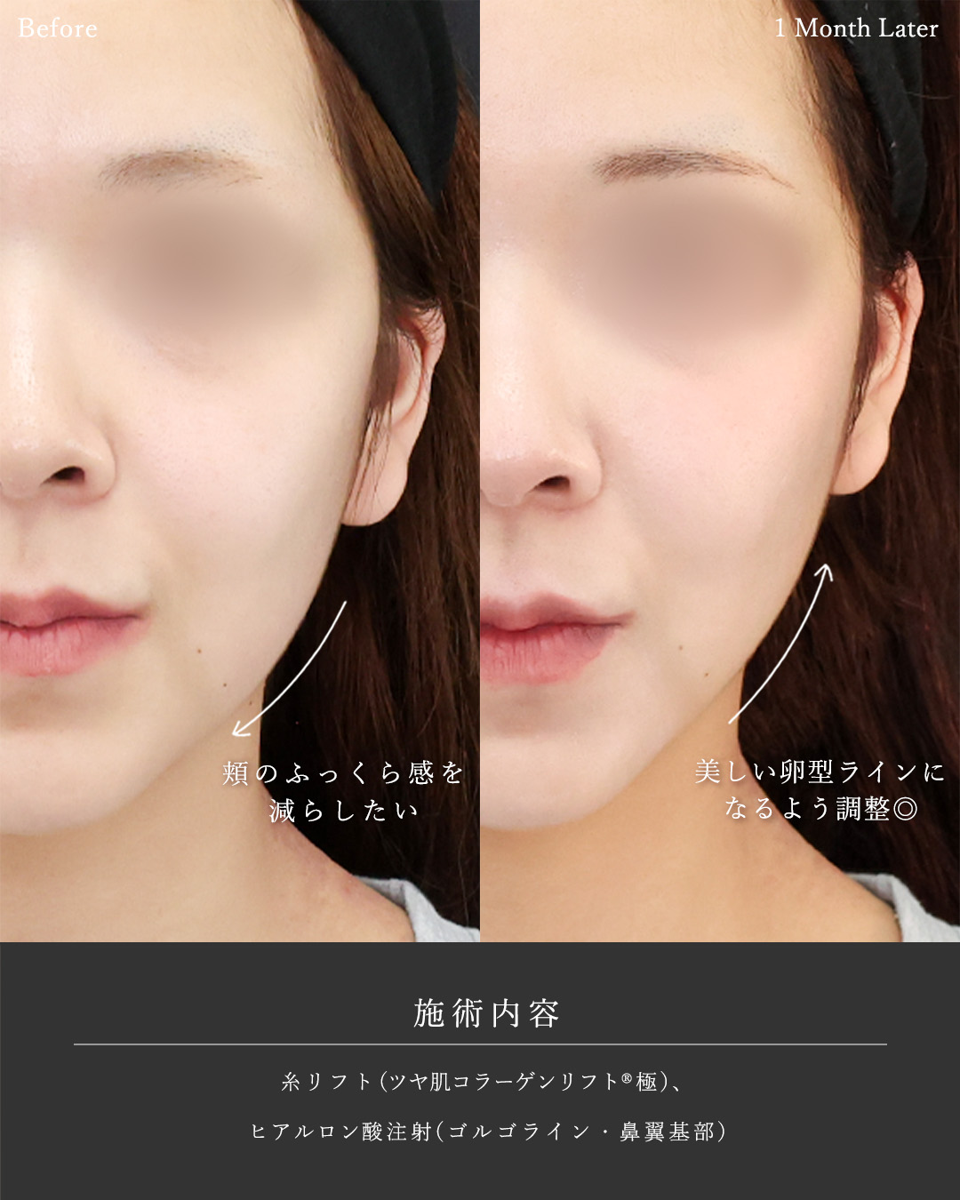 TAC式 ツヤ肌コラーゲンリフト®/ゴルゴ線のヒアルロン酸注射/ヒアルロン酸注射：その他の症例写真 施術前後 