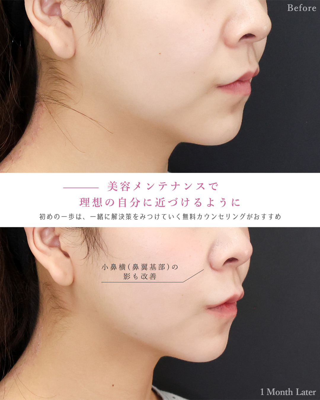TAC式 ツヤ肌コラーゲンリフト®/ゴルゴ線のヒアルロン酸注射/ヒアルロン酸注射：その他の症例写真 施術前後 