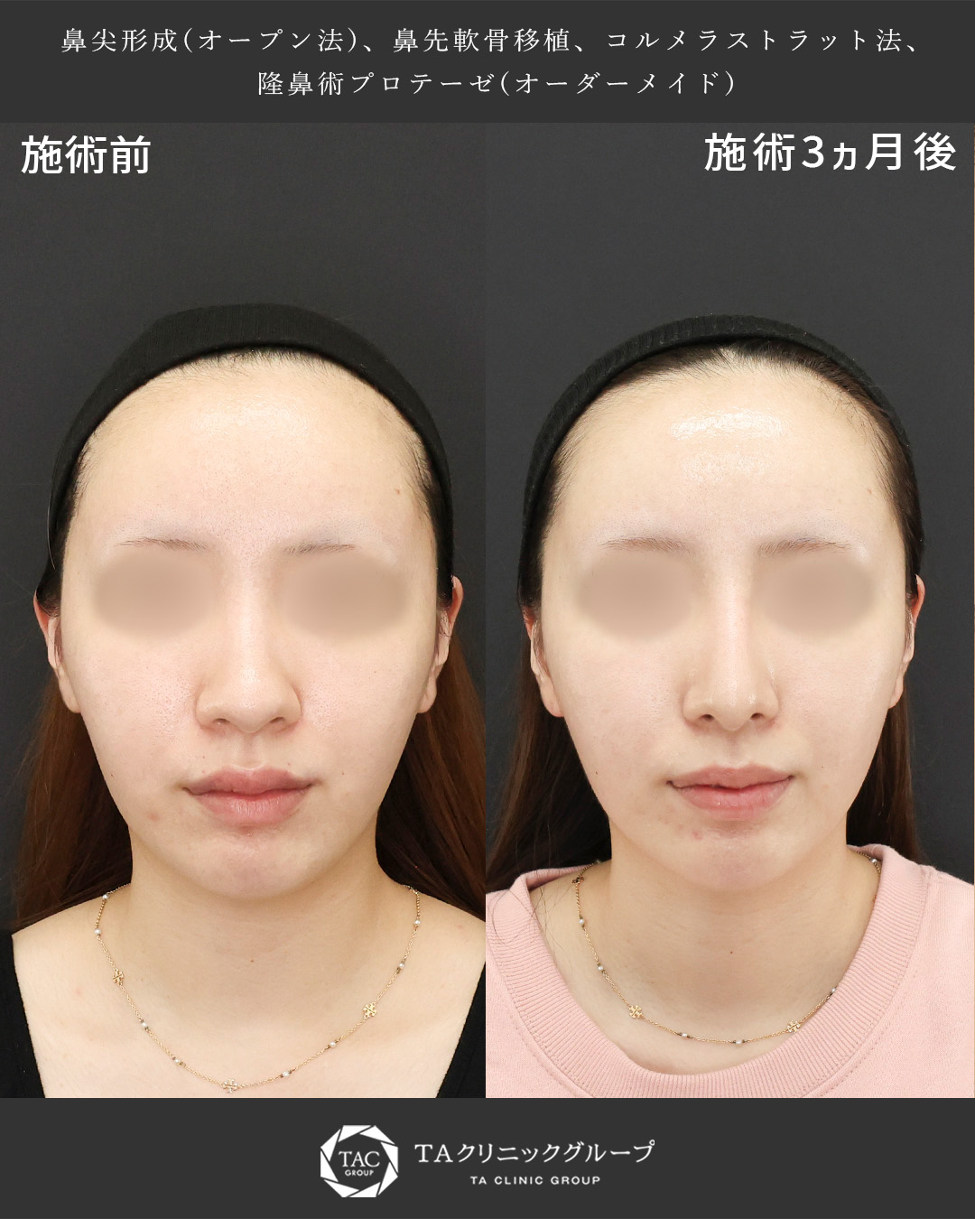 鼻尖形成・鼻尖縮小/鼻先軟骨移植/隆鼻術（プロテーゼ・自家組織）の症例写真 施術前後 
