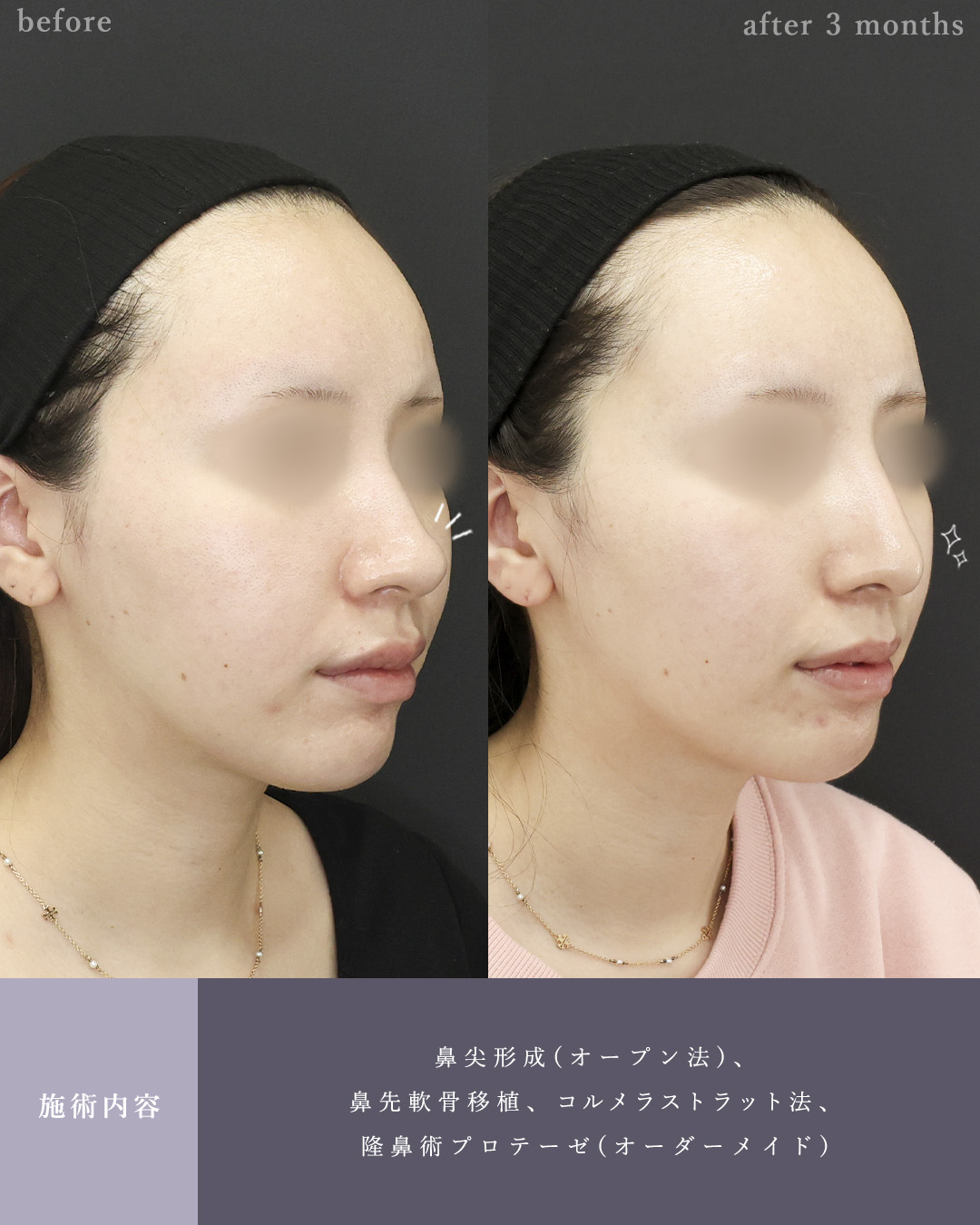 鼻尖形成・鼻尖縮小/鼻先軟骨移植/隆鼻術（プロテーゼ・自家組織）の症例写真 施術前後 